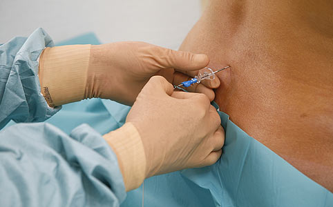 Epidurális érzéstelenítés – hasznos vagy veszélyes?