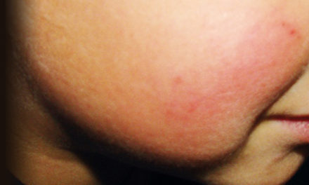 Az ötödik betegség