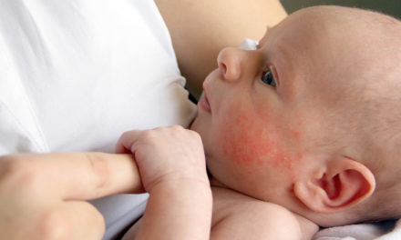 Véres széklet babakorban: Tejallergia tünete is lehet