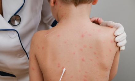 Kötelező lett a bárányhimlő elleni védőoltás Szerbiában a 12 éven felülieknek