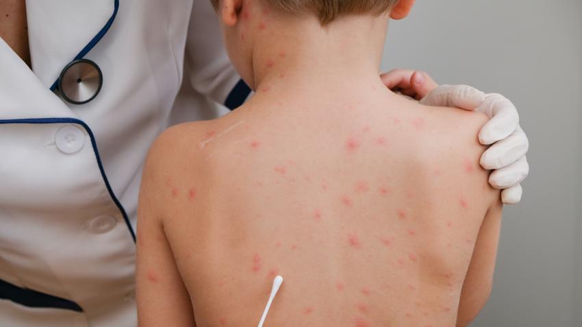 Kötelező lett a bárányhimlő elleni védőoltás Szerbiában a 12 éven felülieknek