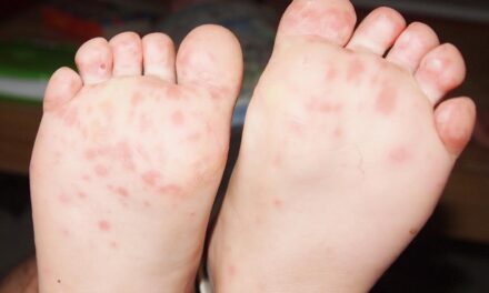 Sebek a szájban, hólyagok a tenyéren, magas láz – A kéz-láb-száj betegségről