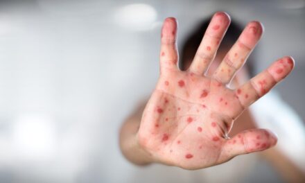 Ebben a városban már kanyarójárvány van