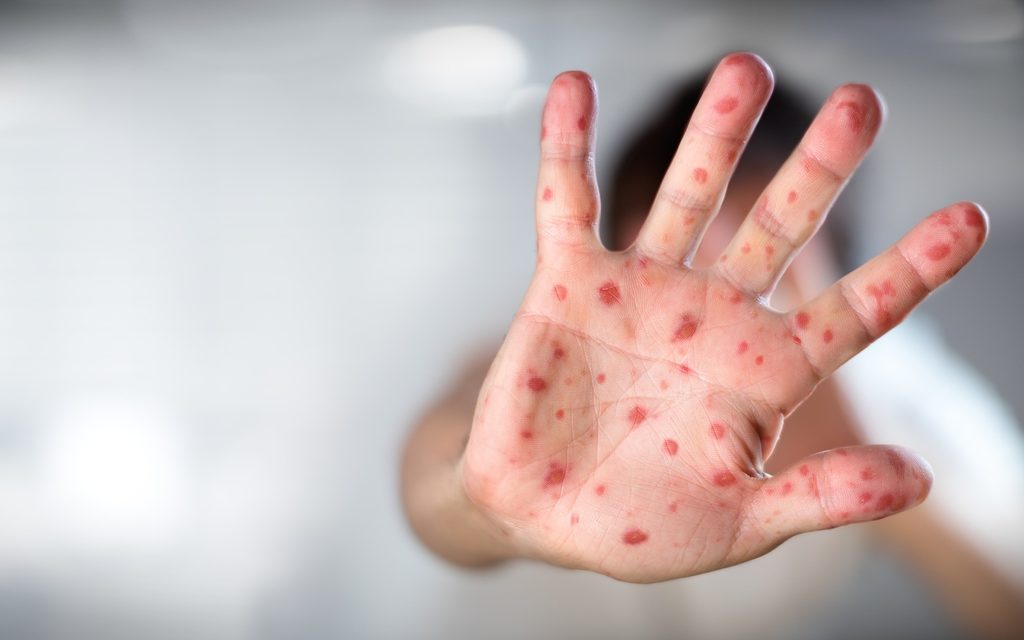 Ebben a városban már kanyarójárvány van